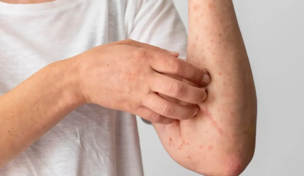 Casos importados de sarampión en Colombia. Foto: Freepik